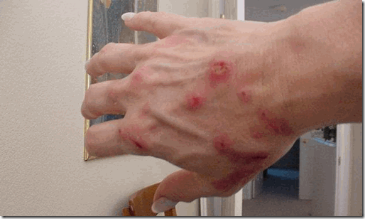 morgellons